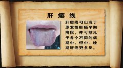 贵州卫视养生李忠博士 护肝解酒饮保护肝脏