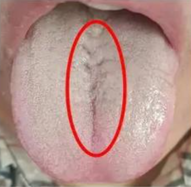 舌苔中间有裂纹的5种原因，分享给你5种中成药对症调